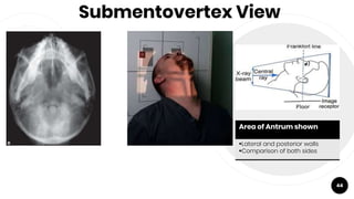 Submentovertex View
44
Area of Antrum shown
Lateral and posterior walls
Comparison of both sides
 