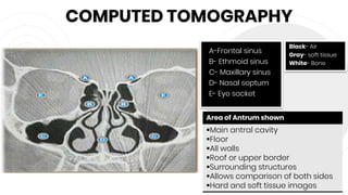 COMPUTED TOMOGRAPHY
46
A-Frontal sinus
B- Ethmoid sinus
C- Maxillary sinus
D- Nasal septum
E- Eye socket
Black- Air
Gray- soft tissue
White- Bone
Area of Antrum shown
Main antral cavity
Floor
All walls
Roof or upper border
Surrounding structures
Allows comparison of both sides
Hard and soft tissue images
 
