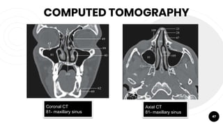 COMPUTED TOMOGRAPHY
47
Coronal CT
81- maxillary sinus
Axial CT
81- maxillary sinus
 