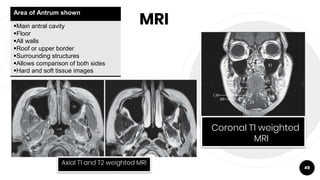 MRI
49
Coronal T1 weighted
MRI
Axial T1 and T2 weighted MRI
Area of Antrum shown
Main antral cavity
Floor
All walls
Roof or upper border
Surrounding structures
Allows comparison of both sides
Hard and soft tissue images
 