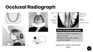 Occlusal Radiograph
61
MAXILLARY CROSS SECTIONAL
VIEW
Area of Antrum shown
Antero-inferior aspects of
each antrum
Relationship with upper
posterior teeth
 