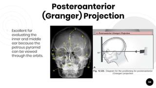 Posteroanterior
(Granger) Projection
￮ Excellent for
evaluating the
inner and middle
ear because the
petrous pyramid
can be viewed
through the orbits.
64
 