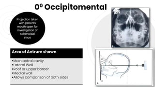 00 Occipitomental
66
Area of Antrum shown
Main antral cavity
Lateral Wall
Roof or upper border
Medial wall
Allows comparison of both sides
Projection taken
with patients
mouth open for
investigation of
sphenoidal
sinus
 