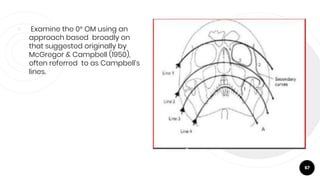 ￮ Examine the 0° OM using an
approach based broadly on
that suggested originally by
McGregor & Campbell (1950),
often referred to as Campbell's
lines.
67
 