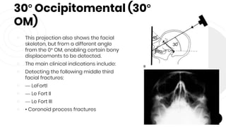 30° Occipitomental (30°
OM)
￮ This projection also shows the facial
skeleton, but from a different angle
from the 0° OM, enabling certain bony
displacements to be detected.
￮ The main clinical indications include:
￮ Detecting the following middle third
facial fractures:
￮ — LeFortI
￮ — Le Fort II
￮ — Le Fort III
￮ • Coronoid process fractures
69
 