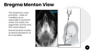Bregma Menton View
￮ This projection used
primarily – walls of
maxillary sinus-
especially in posterior
areas, the orbits, the
zygomatic arches and
the nasal septum
￮ Demonstrated medial
or lateral deviations of
the mandible
70
 