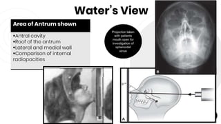 Water’s View
71
Area of Antrum shown
Antral cavity
Roof of the antrum
Lateral and medial wall
Comparison of internal
radiopacities
 