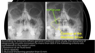82
According to Veterans Affairs general medicine clinic study, the accuracy of
diagnosing sinusitis increases to more than 80% if the following criteria are
considered in the water’s view:
1. Presence of air fluid level
2. Sinus opacity
3. Mucosal thickening greater than 6 mm
 