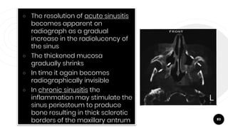 83
￮ The resolution of acute sinusitis
becomes apparent on
radiograph as a gradual
increase in the radiolucency of
the sinus
￮ The thickened mucosa
gradually shrinks
￮ In time it again becomes
radiographically invisible
￮ In chronic sinusitis the
inflammation may stimulate the
sinus periosteum to produce
bone resulting in thick sclerotic
borders of the maxillary antrum
 