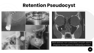 Retention Pseudocyst
85
Well defined, non corticated, smooth, dome
shaped, homogeneous radiopaque mass
 