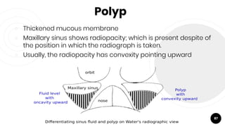 Polyp
￮ Thickened mucous membrane
￮ Maxillary sinus shows radiopacity; which is present despite of
the position in which the radiograph is taken.
￮ Usually, the radiopacity has convexity pointing upward
87
 