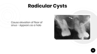 Radicular Cysts
￮ Cause elevation of floor of
sinus - Appears as a halo
93
 