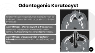 Odontogenic Keratocyst
95
Keratocystic odontogenic tumor, maxilla; 16-year-old
male with painless expansion of maxilla,complicated
by sinusitis.
Axial CT image (after biopsy with a drain in place)
shows expansive process in left maxillary sinus
(arrow), multilocular in posterior part (arrowheads).
Axial CT image shows expansion of posterior
thinned sinus wall with cortical defects (arrow), and
fluid.
 