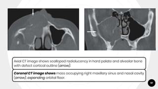 97
Axial CT image shows scalloped radiolucency in hard palate and alveolar bone
with defect cortical outline (arrow).
Coronal CT image shows mass occupying right maxillary sinus and nasal cavity
(arrow), expanding orbital floor.
 