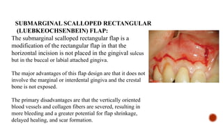Marginal Tooth Incision SEMINAR IN ENDODONTICS SURGICAL ENDODONTICS.pptx