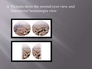  Pictures show the normal eyes view and
bitemporal hemianopia view
 
