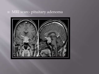  MRI scan:- pituitary adenoma
 