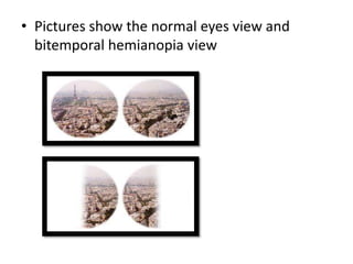 • Pictures show the normal eyes view and
bitemporal hemianopia view

 