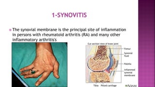  The synovial membrane is the principal site of inflammation
in persons with rheumatoid arthritis (RA) and many other
inflammatory arthritis's
 
