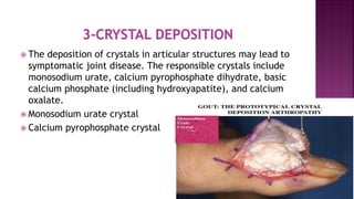  The deposition of crystals in articular structures may lead to
symptomatic joint disease. The responsible crystals include
monosodium urate, calcium pyrophosphate dihydrate, basic
calcium phosphate (including hydroxyapatite), and calcium
oxalate.
 Monosodium urate crystal
 Calcium pyrophosphate crystal
 