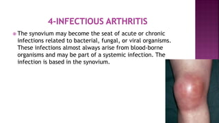  The synovium may become the seat of acute or chronic
infections related to bacterial, fungal, or viral organisms.
These infections almost always arise from blood-borne
organisms and may be part of a systemic infection. The
infection is based in the synovium.
 