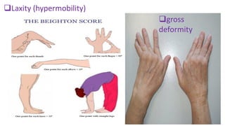 Laxity (hypermobility)
gross
deformity
 
