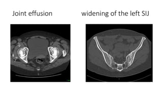 Joint effusion widening of the left SIJ
 
