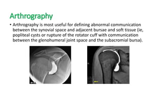 Arthrography
• Arthrography is most useful for defining abnormal communication
between the synovial space and adjacent bursae and soft tissue (ie,
popliteal cysts or rupture of the rotator cuff with communication
between the glenohumeral joint space and the subacromial bursa).
 