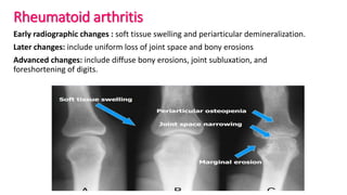 Rheumatoid arthritis
Early radiographic changes : soft tissue swelling and periarticular demineralization.
Later changes: include uniform loss of joint space and bony erosions
Advanced changes: include diffuse bony erosions, joint subluxation, and
foreshortening of digits.
 