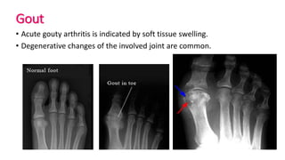 Gout
• Acute gouty arthritis is indicated by soft tissue swelling.
• Degenerative changes of the involved joint are common.
 
