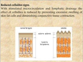 Reduced cellulites signs.
With stimulated microcirculation and lymphatic drainage the
effect of cellulites is reduced by preventing excessive swelling of
skin fat cells and diminishing conjunctive tissue contraction.
 
