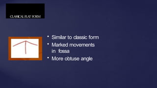 CLASSICALFLA
T FORM
• Similar to classic form
• Marked movements
in fossa
• More obtuse angle
 