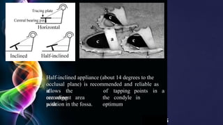 5
Page 3
Half-inclined appliance (about 14 degrees to the
occlusal plane) is recommended and reliable as
it
allows the
recording
points in a
convergent area
with
of tapping
the condyle in
optimum
position in the fossa.
 