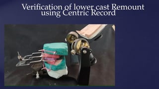 Verification of lower cast Remount
using Centric Record
 