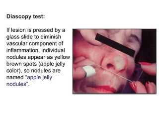 Diascopy test:
If lesion is pressed by a
glass slide to diminish
vascular component of
inflammation, individual
nodules appear as yellow
brown spots (apple jelly
color), so nodules are
named “apple jelly
nodules”.

 