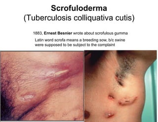 Scrofuloderma
(Tuberculosis colliquativa cutis)
1883, Ernest Besnier wrote about scrofulous gumma
Latin word scrofa means a breeding sow, b/c swine
were supposed to be subject to the complaint

 