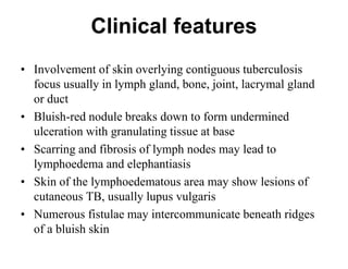 Clinical features
• Involvement of skin overlying contiguous tuberculosis
focus usually in lymph gland, bone, joint, lacrymal gland
or duct
• Bluish-red nodule breaks down to form undermined
ulceration with granulating tissue at base
• Scarring and fibrosis of lymph nodes may lead to
lymphoedema and elephantiasis
• Skin of the lymphoedematous area may show lesions of
cutaneous TB, usually lupus vulgaris
• Numerous fistulae may intercommunicate beneath ridges
of a bluish skin

 