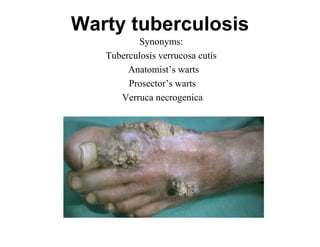 Warty tuberculosis
Synonyms:
Tuberculosis verrucosa cutis
Anatomist’s warts
Prosector’s warts
Verruca necrogenica

 