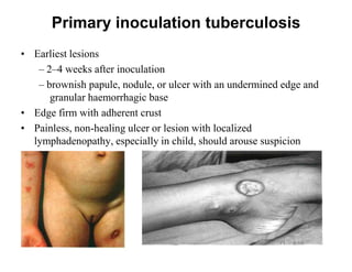 Primary inoculation tuberculosis
• Earliest lesions
– 2–4 weeks after inoculation
– brownish papule, nodule, or ulcer with an undermined edge and
granular haemorrhagic base
• Edge firm with adherent crust
• Painless, non-healing ulcer or lesion with localized
lymphadenopathy, especially in child, should arouse suspicion

 