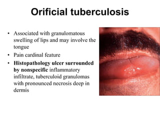 Orificial tuberculosis
• Associated with granulomatous
swelling of lips and may involve the
tongue
• Pain cardinal feature
• Histopathology ulcer surrounded
by nonspecific inflammatory
infiltrate, tuberculoid granulomas
with pronounced necrosis deep in
dermis

 