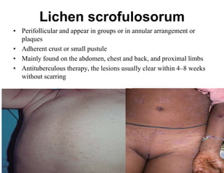 Lichen scrofulosorum
• Perifollicular and appear in groups or in annular arrangement or
plaques
• Adherent crust or small pustule
• Mainly found on the abdomen, chest and back, and proximal limbs
• Antituberculous therapy, the lesions usually clear within 4–8 weeks
without scarring

 