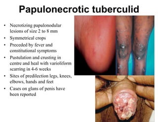 Papulonecrotic tuberculid
• Necrotizing papulonodular
lesions of size 2 to 8 mm
• Symmetrical crops
• Preceded by fever and
constitutional symptoms
• Pustulation and crusting in
centre and heal with varioliform
scarring in 4-6 weeks
• Sites of predilection legs, knees,
elbows, hands and feet
• Cases on glans of penis have
been reported

 