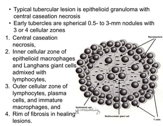 • Typical tubercular lesion is epithelioid granuloma with
central caseation necrosis
• Early tubercles are spherical 0.5- to 3-mm nodules with
3 or 4 cellular zones
1. Central caseation
necrosis,
2. Inner cellular zone of
epithelioid macrophages
and Langhans giant cells
admixed with
lymphocytes,
3. Outer cellular zone of
lymphocytes, plasma
cells, and immature
macrophages, and
4. Rim of fibrosis in healing
lesions.

 