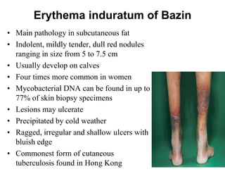 Erythema induratum of Bazin
• Main pathology in subcutaneous fat
• Indolent, mildly tender, dull red nodules
ranging in size from 5 to 7.5 cm
• Usually develop on calves
• Four times more common in women
• Mycobacterial DNA can be found in up to
77% of skin biopsy specimens
• Lesions may ulcerate
• Precipitated by cold weather
• Ragged, irregular and shallow ulcers with
bluish edge
• Commonest form of cutaneous
tuberculosis found in Hong Kong

 