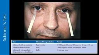 Schirmer’sTest
 