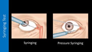 SyringingTest
Syringing Pressure Syringing
 