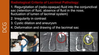 DCG Radiological Criteria of Lacrimal Pathology:
1. Regurgitation of (radio-opaque) fluid into the conjunctival
sac (retention of fluid, absence of fluid in the nose,
fluctuation of lumen of lacrimal system)
2. Irregularity in contrast
3. Cystic dilation and aneurysm
4. Deformation and drawing of the lacrimal sac
 