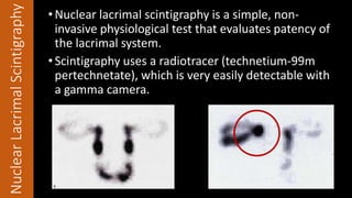 NuclearLacrimalScintigraphy •Nuclear lacrimal scintigraphy is a simple, non-
invasive physiological test that evaluates patency of
the lacrimal system.
•Scintigraphy uses a radiotracer (technetium-99m
pertechnetate), which is very easily detectable with
a gamma camera.
 