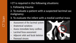 CTScan •CT is required in the following situations:
1. Following trauma
2. To evaluate a patient with a suspected lacrimal sac
malignancy
3. To evaluate the infant with a medial canthal mass
 