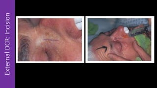 ExternalDCR:Incision
 